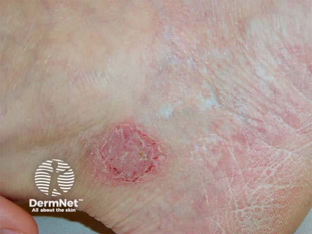 Irritant dermatitis from