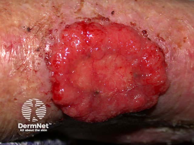 Basal cell carcinoma