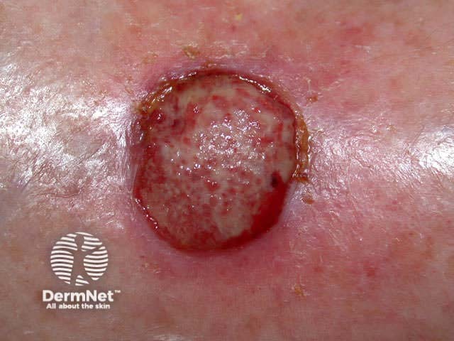 Squamous cell carcinoma