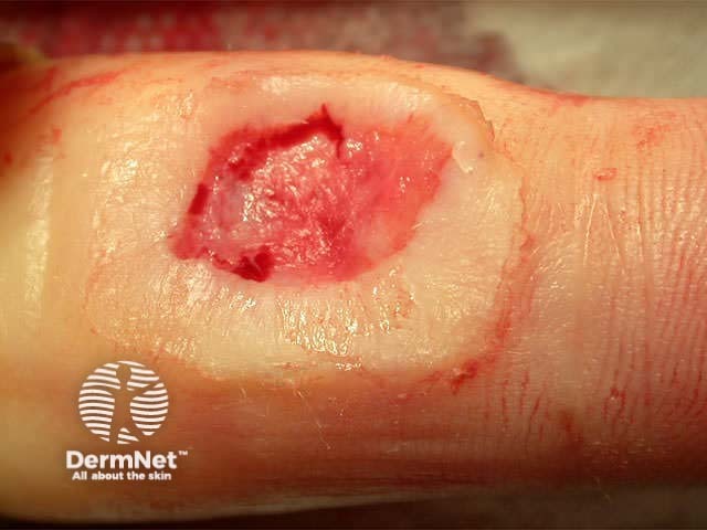 Acute surgical wound