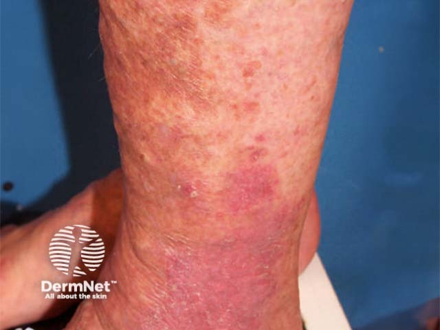 Typical stasis dermatitis