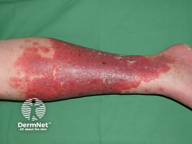 Dermatitis due to