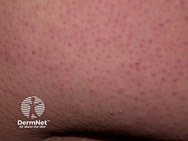 Keratosis pilaris