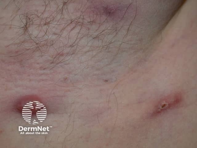 Hidradenitis suppurativa in Down syndrome