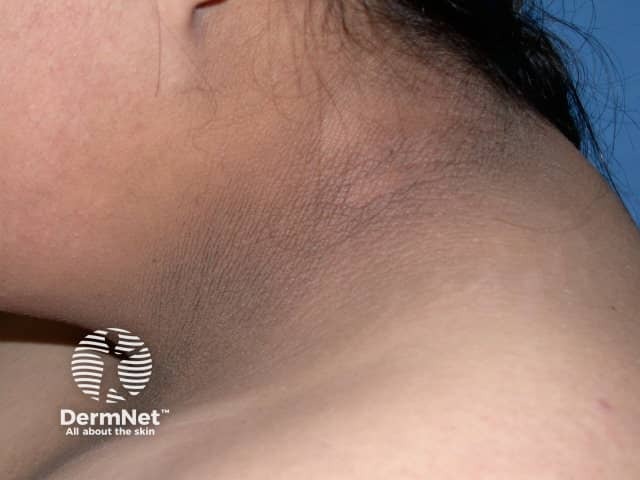 Acanthosis nigricans