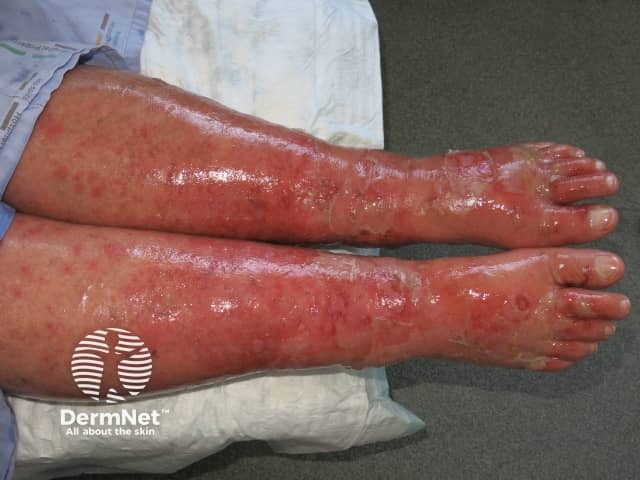 Toxic epidermal necrolysis