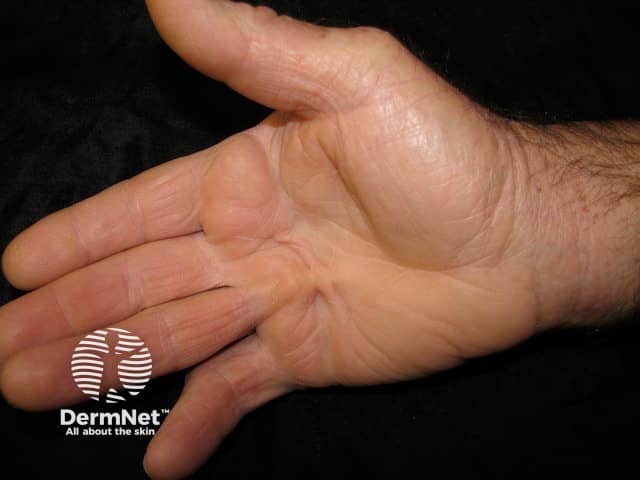 Dupuytren contracture