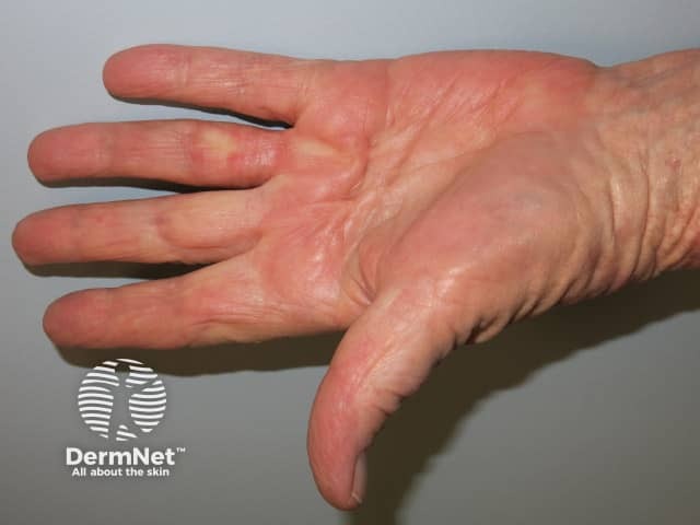 Dupuytren contracture