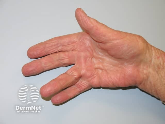 Dupuytren contracture