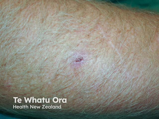 Eroding basal cell carcinoma, arm