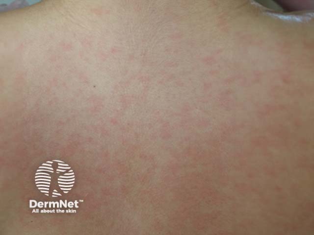 Rash due to infectious mononucleosis plus amoxicillin