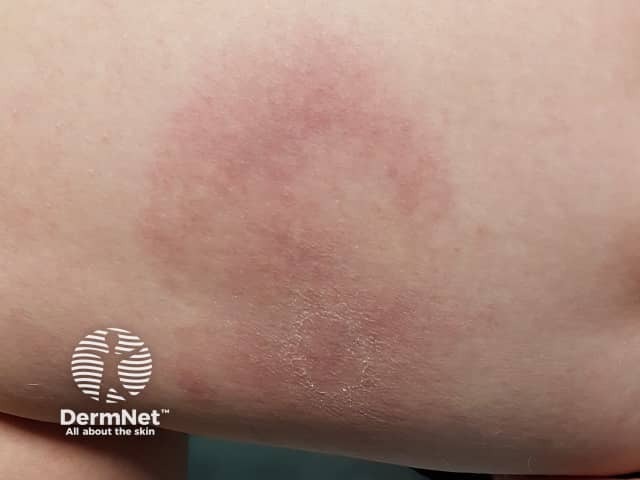 Erythema chronicum migrans