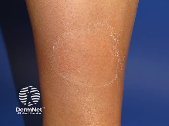 Erythema chronicum migrans