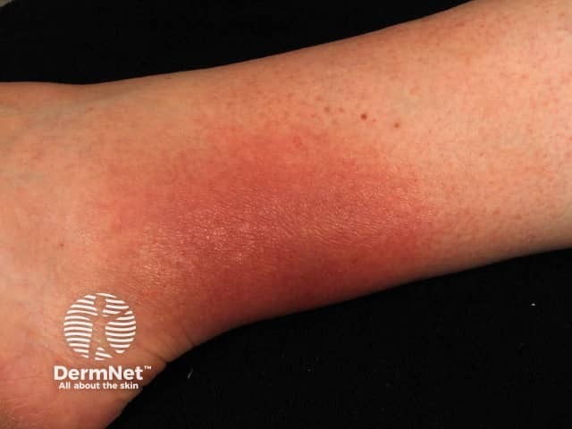 Erythema chronicum migrans