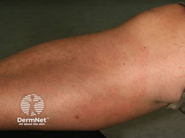 Erythema chronicum migrans