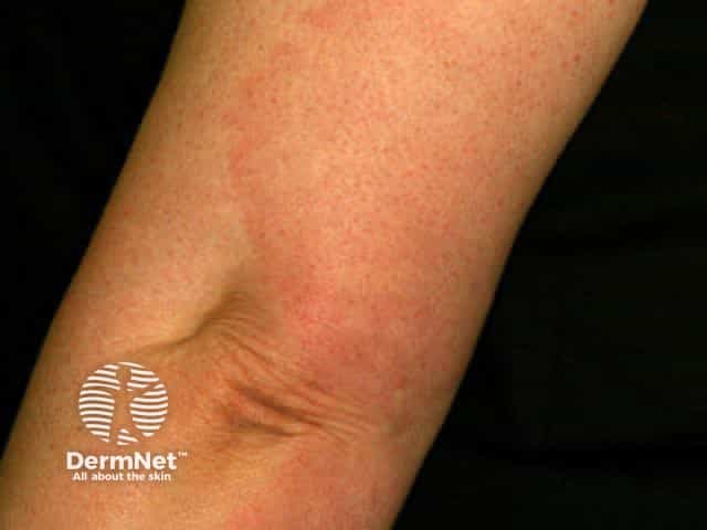 Erythema chronicum migrans