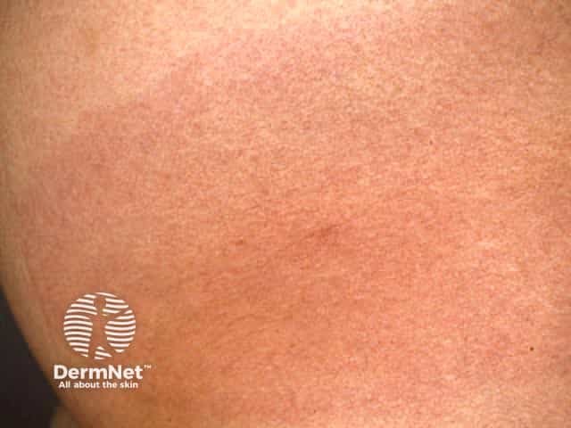 Erythema chronicum migrans