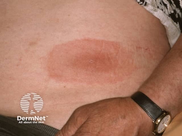 Erythema chronicum migrans