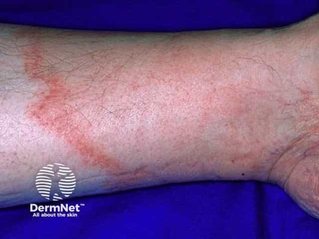 Erythema chronicum migrans