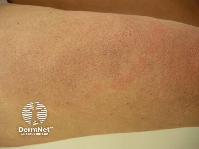 Erythema chronicum migrans