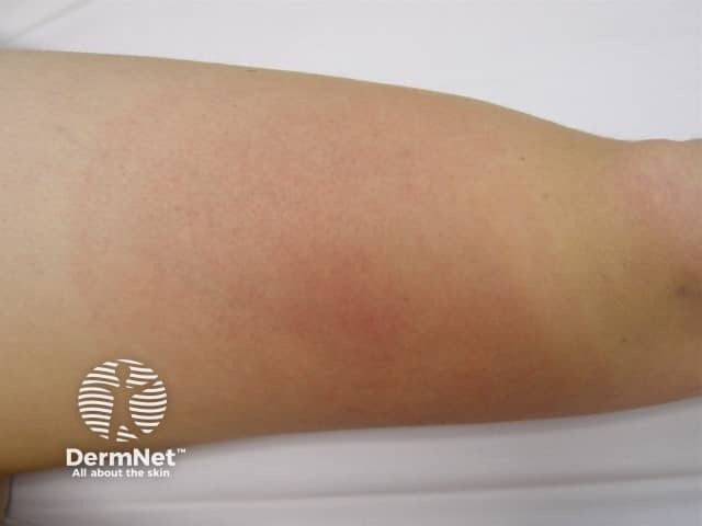 Erythema chronicum migrans