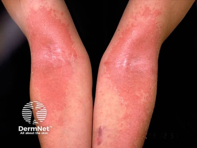 Atopic dermatitis