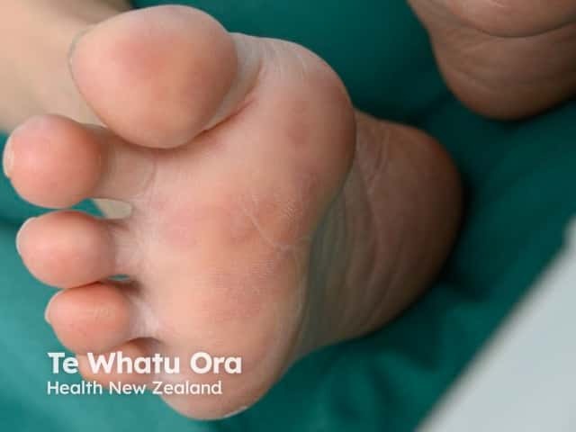 Hand Foot and Mouth Disease