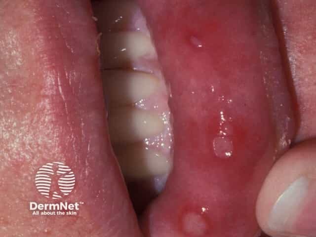 Hand foot and mouth disease