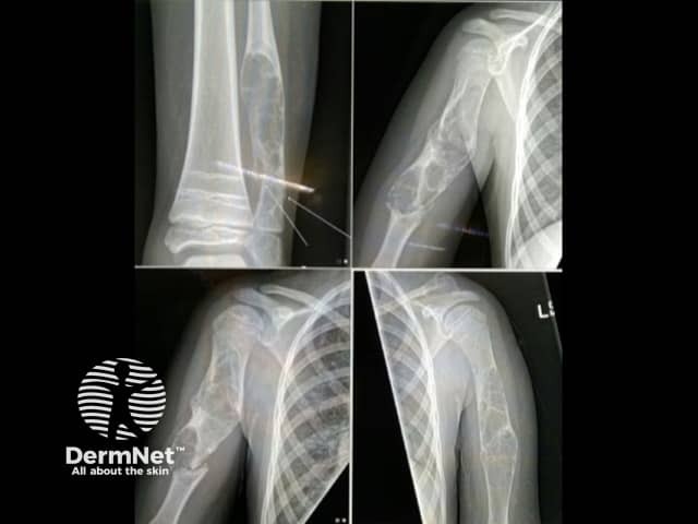 Epidermal naevus syndrome - skeletal defects