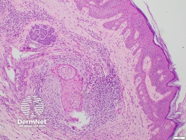 Histology of epithelial sheath neuroma