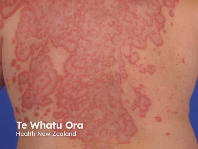 Erythema gyratum repens-like appearance in pemphigus foliaceus