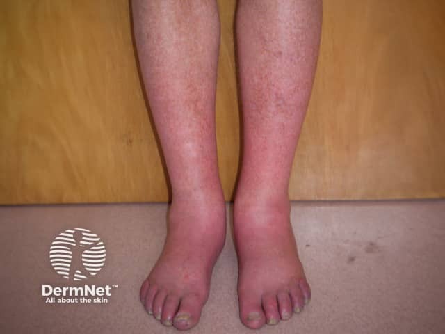 Erythromelalgia