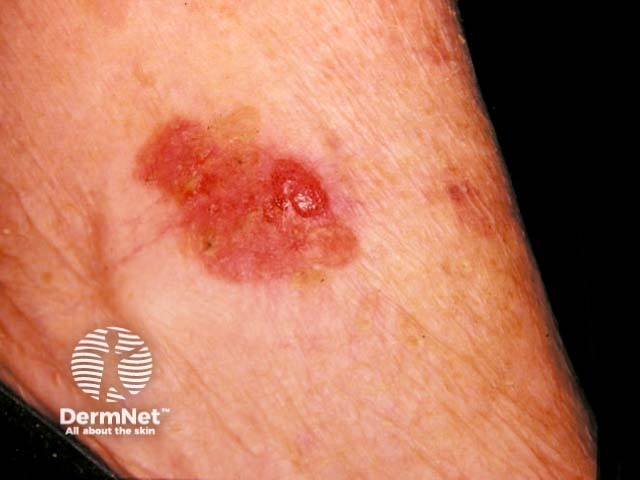 Extramammary Paget disease of the skin of the axilla