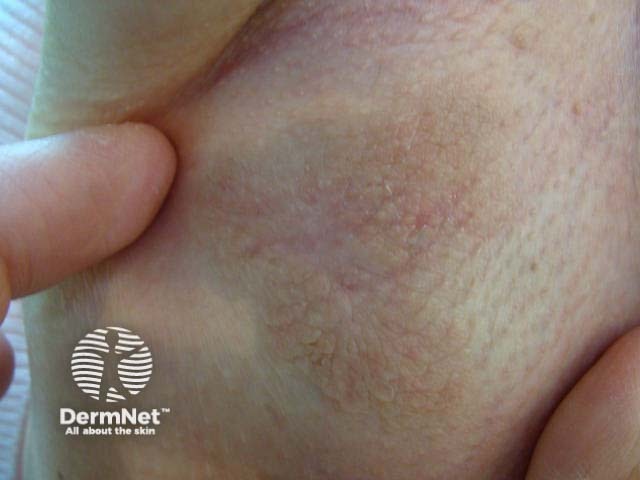 Extramammary Paget disease of the skin of the axilla