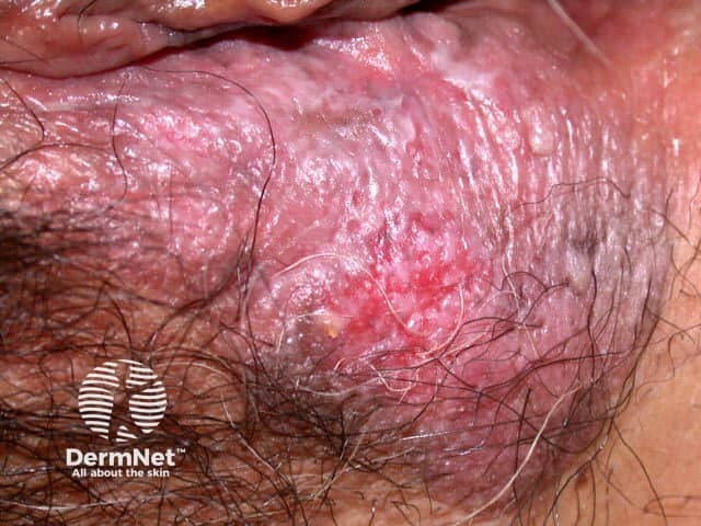 Extramammary Paget disease of the skin of the vulva