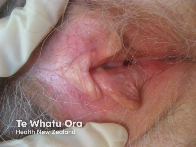 Extramammary Paget disease of the skin of the vulva