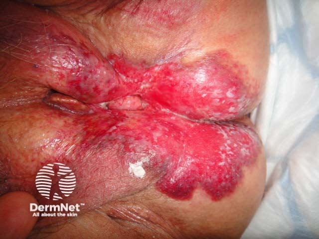 Perianal extramammary Paget disease of the skin