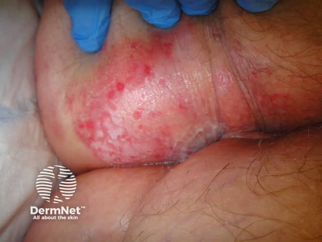 Perianal extramammary Paget disease of the skin