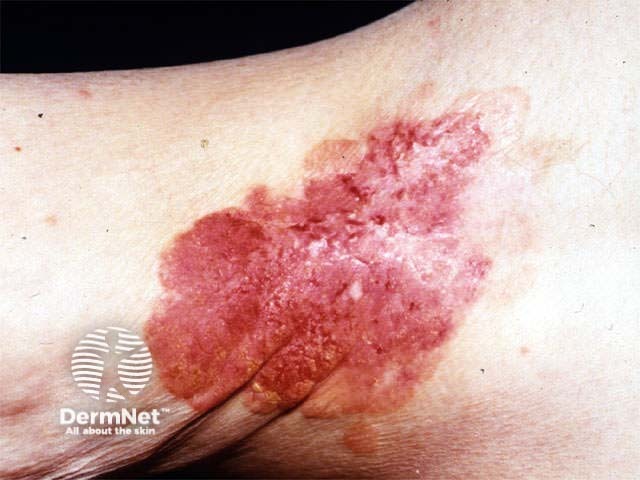 Extramammary Paget disease of the skin of the axilla