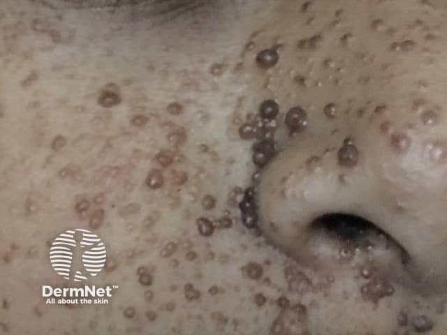 Angiofibromas in tuberous sclerosis