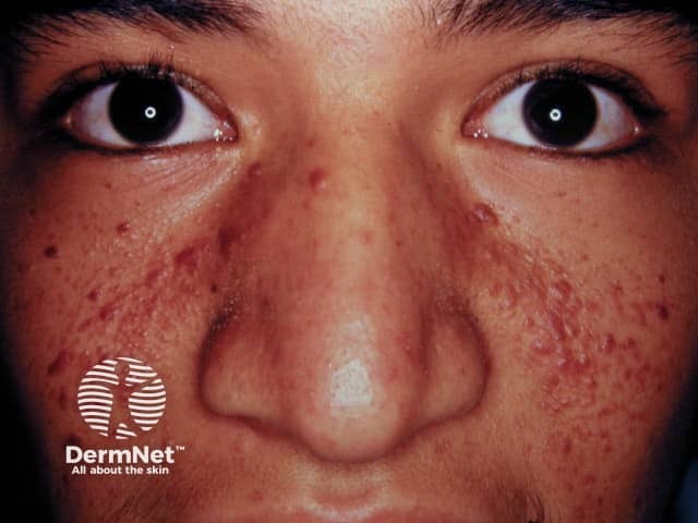 Angiofibromas in tuberous sclerosis