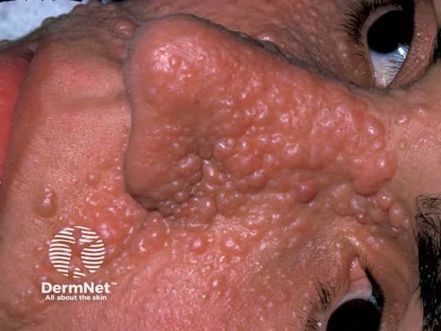 Angiofibromas in tuberous sclerosis