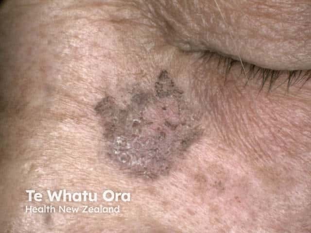 Pigmented actinic keratosis