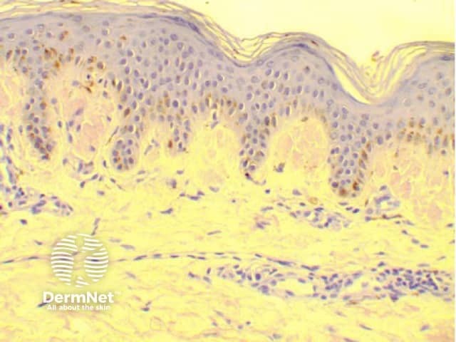 Skin biopsy stained with Congo red staining, which highlights the amyloid deposits