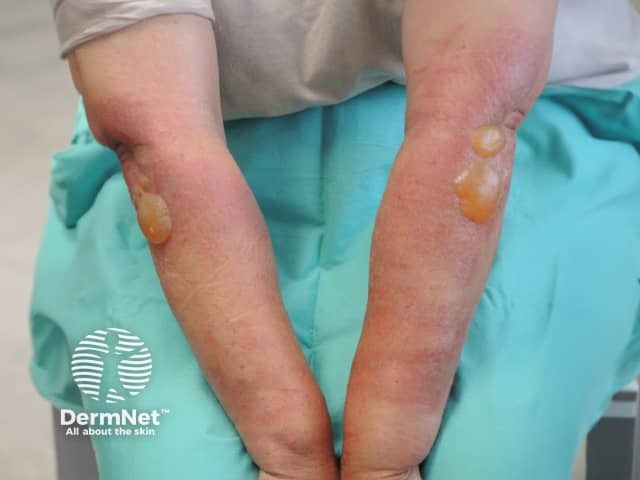 Fig dermatitis