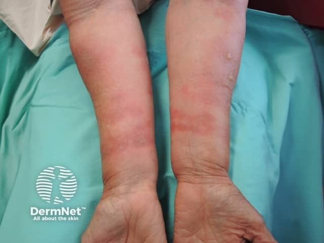 Fig dermatitis