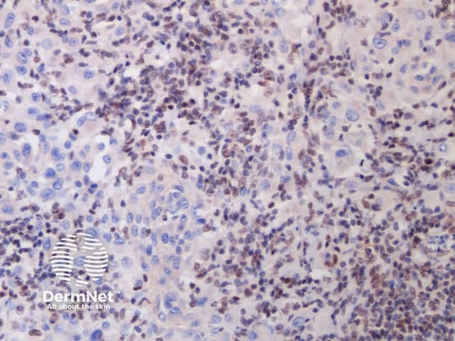 d. x 20, immunohistochemistry