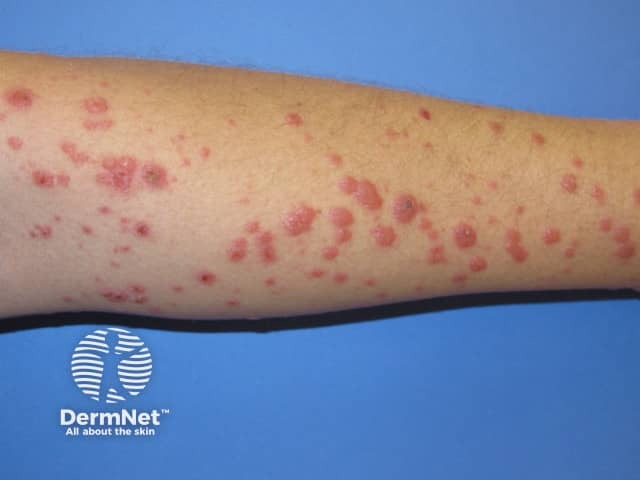 Erythema multiforme