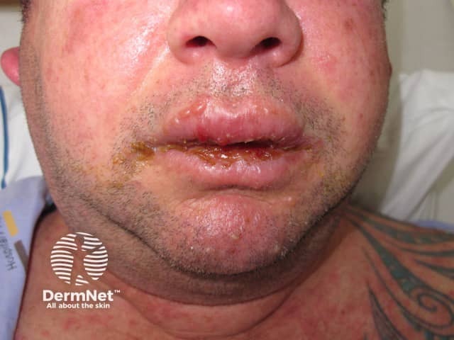 Stevens-Johnson syndrome / toxic epidermal necrolysis