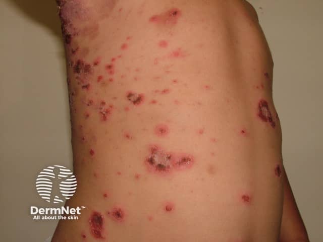 Impetigo